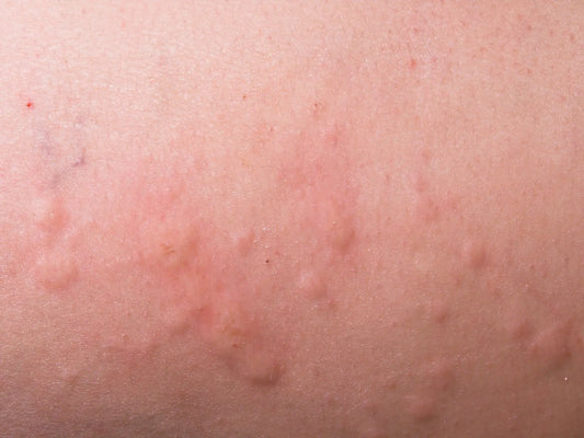 Eczema e orticaria: è bene fare un po' di chiarezza